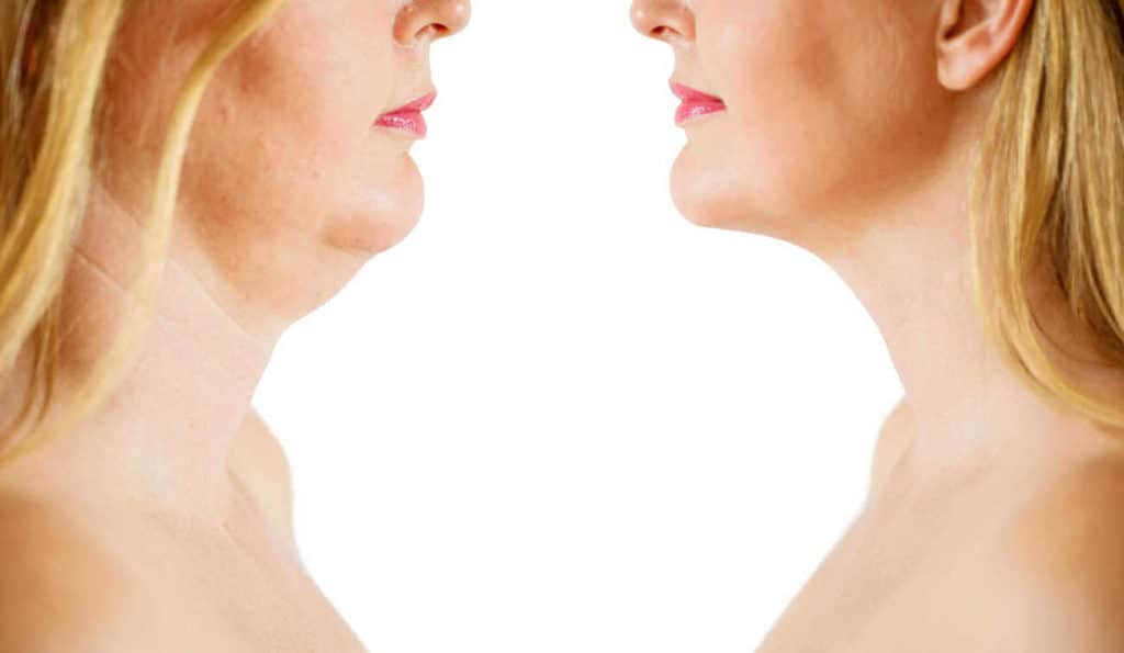 Double Chin treatment Wallingford before and after results