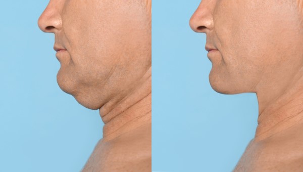 Which Non-Surgical Treatments Work Best for Jowls and Loose Skin Wallingford?