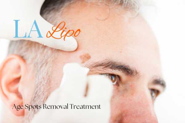 What Are the Most Effective Treatments for Age Spots Wallingford?