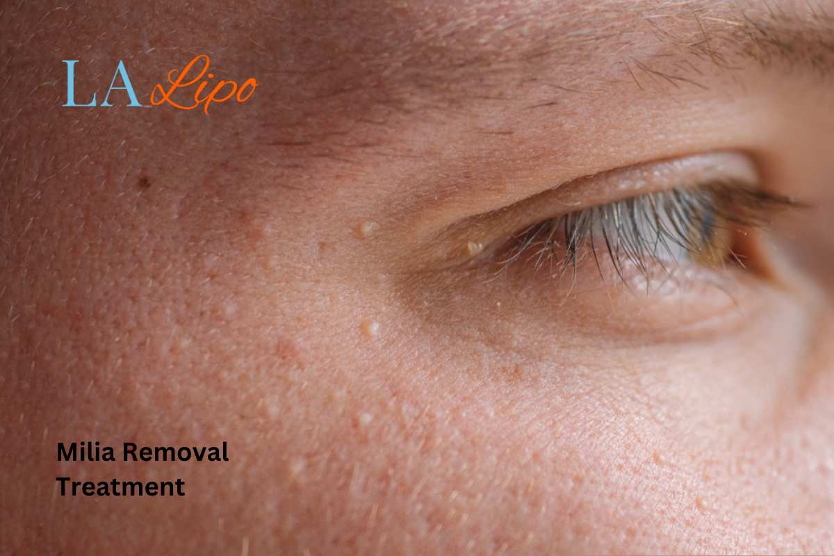 Cryopen Milia Removal: Is It the Easiest and Safest Option Wallingford?