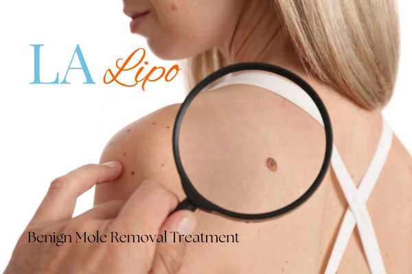 Woman having her inspection of blemish before mole removal Wallingford