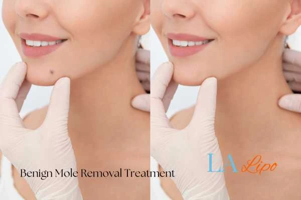 Before and after mole removal Wallingford treatment