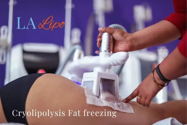 women getting fat freezing Wallingford