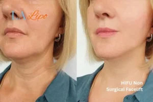 hi-fu for wrinkles Wallingford before and after results