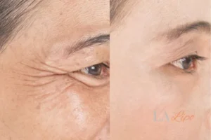 Before and after results of woman - HI-fu wrinkles reduction treatment Wallingford
