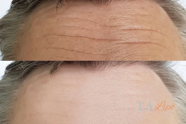 results of HIFU Wallingford on mans forehead to help reduce lines and wrinkles