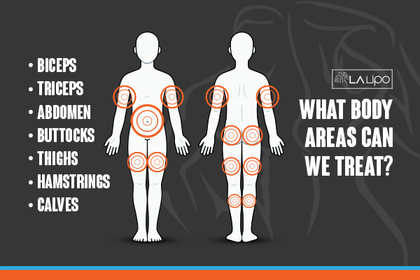 Graphic to show areas you can have LA-EMS Body Sculpting Wallingford treatment.