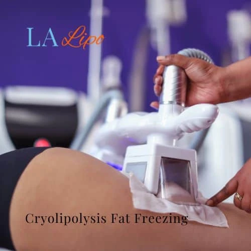 fat freezing - Cryolipolysis Wallingford