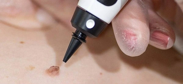 skin tag removal using cryopen Wallingford