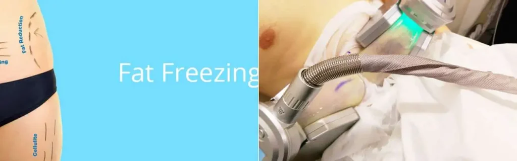 multi areas of a persons body having coolsculpting Wallingford treatment