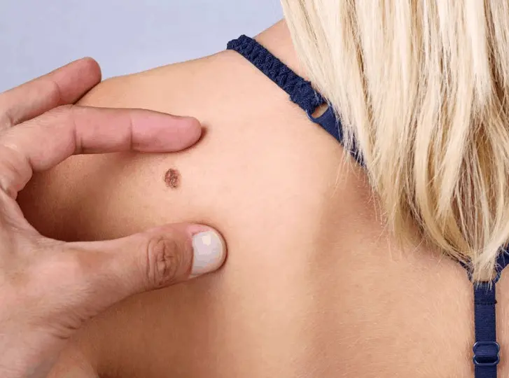 woman having mole removal Wallingford consultation before treatment.