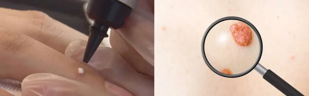 Cryopen for mole removal Wallingford - speak to our team today!