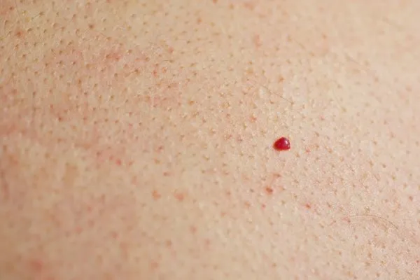 close up of a cherry angioma Wallingford