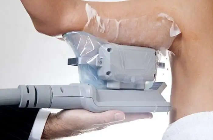 Picture of fat freezing Wallingford on the upper arms.