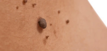 image of a skin tag Wallingford