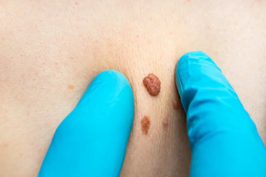 Consultant examining a skin tag Wallingford