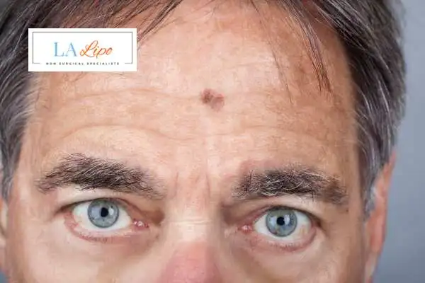 Solar Lentigo Removal Wallingford image of man with mark on his forehead