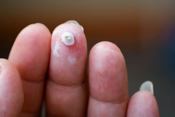wart on person finger - cryotherapy to treat from LA LIPO Wallingford