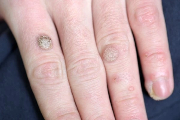 photo of warts on person hand - see wart removal Wallingford from LA LIPO
