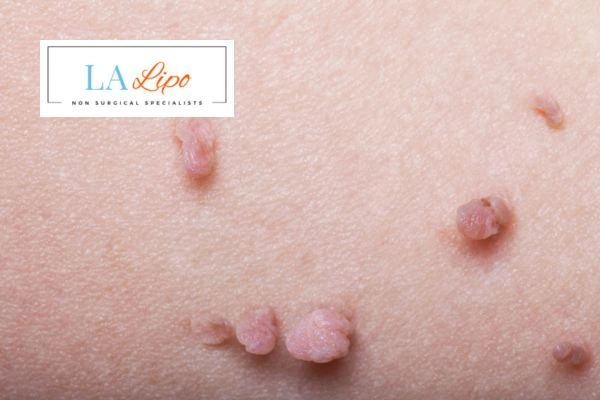 Does cryopen skin tag removal Wallingford hurt? Find out now call our team today!