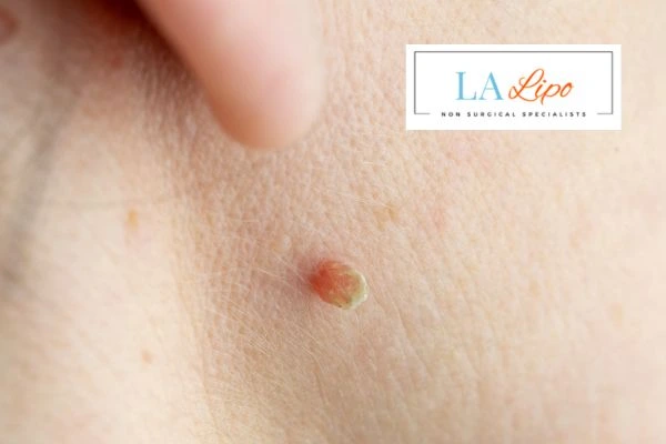 Book skin tag removal Wallingford today speak to our team now!