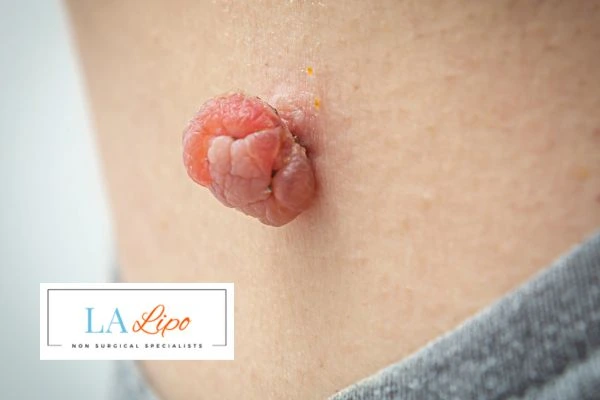 Interested in skin tag removal Wallingford? Concerned about the pain? Find out more today!