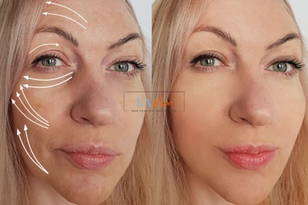 Morpheus 8 results Wallingford face lift.