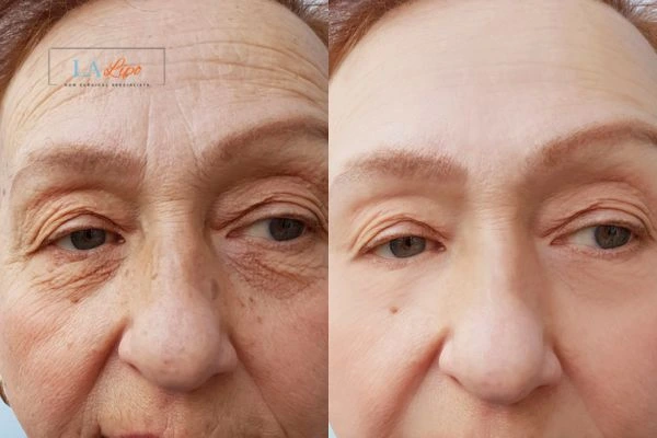 The powerful benefits of Morpheus8 Treatment Wallingford - Call Our team today!