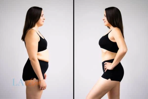 Picture of womans before and after using LA-EMS body sculpting to improve her core strength Wallingford
