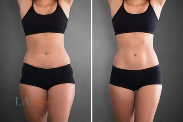 before and after results of non-surgical treatment to help a woman's body image and mental health Wallingford