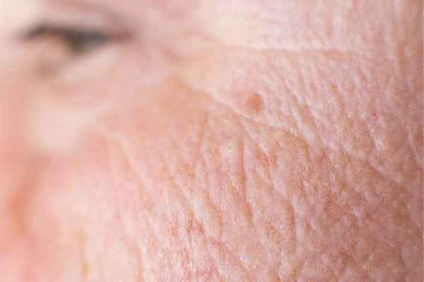 close up picture of a woman's face showing an age spot Wallingford