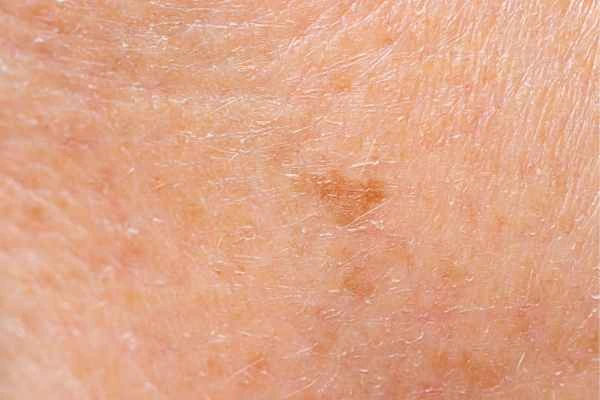 close up picture of age spots Wallingford