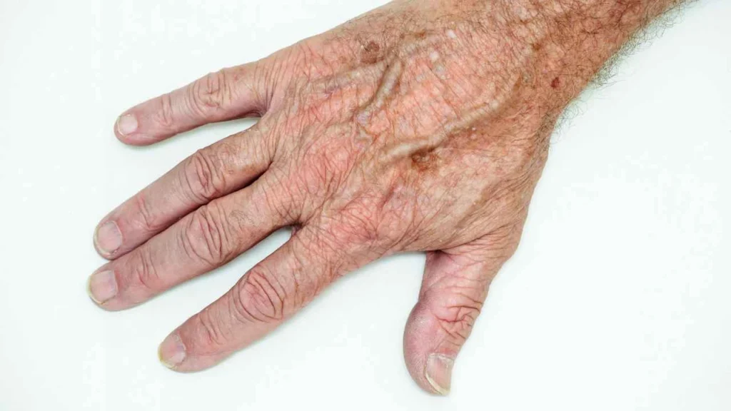 Male hand showing age spot Wallingford