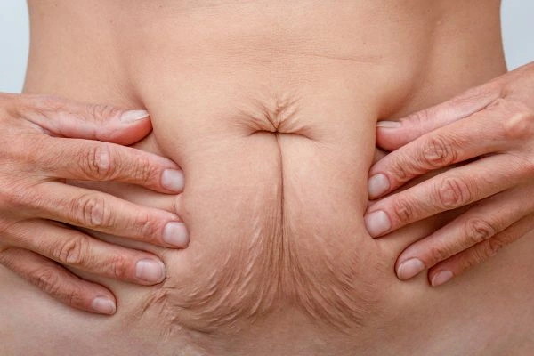 Image of a woman's stomach with loose skin - example of skin tightening Wallingford options