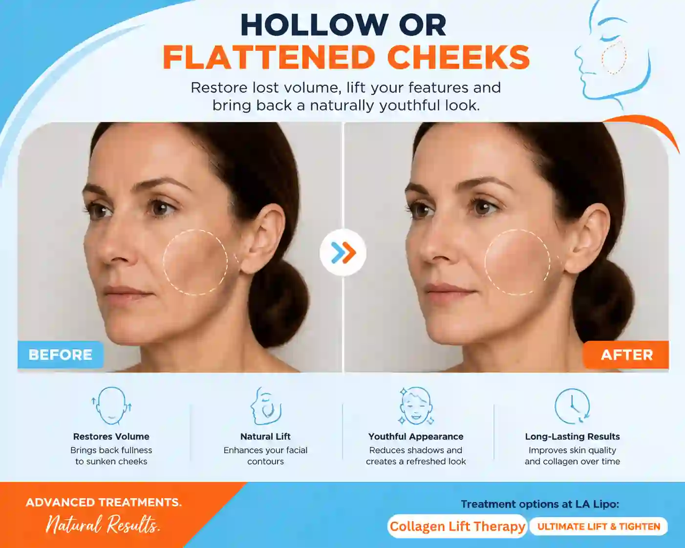 Sign #4: Hollow or Flattened Cheeks Wallingford